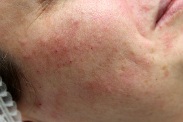 Инъекции красоты — RESTYLANE и JALUPRO. Личный опыт. Уколы Restylane Vital